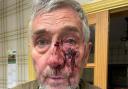 Alan Cummings was injured after a confrontation with three men riding mountain bikes near Cropton Forest