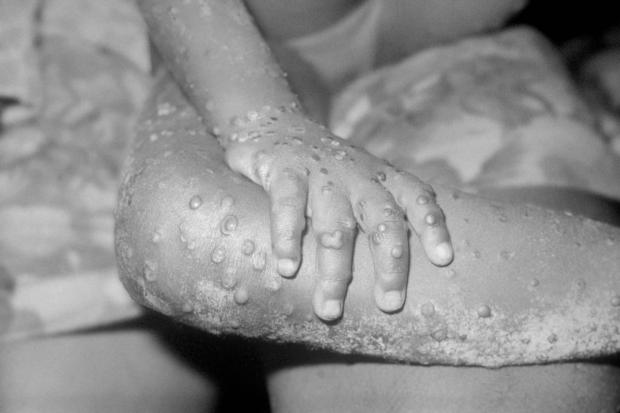 York Press: The monkeypox virus can be spread in a number of ways. Picture: PA