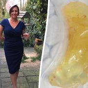 Beth Hewson and her removed breast implant. Picture: SWNS