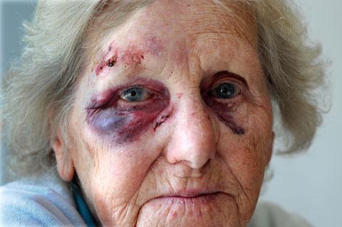 Beryl Hall, 81, who was knocked over by a cyclist who mounted the pavement